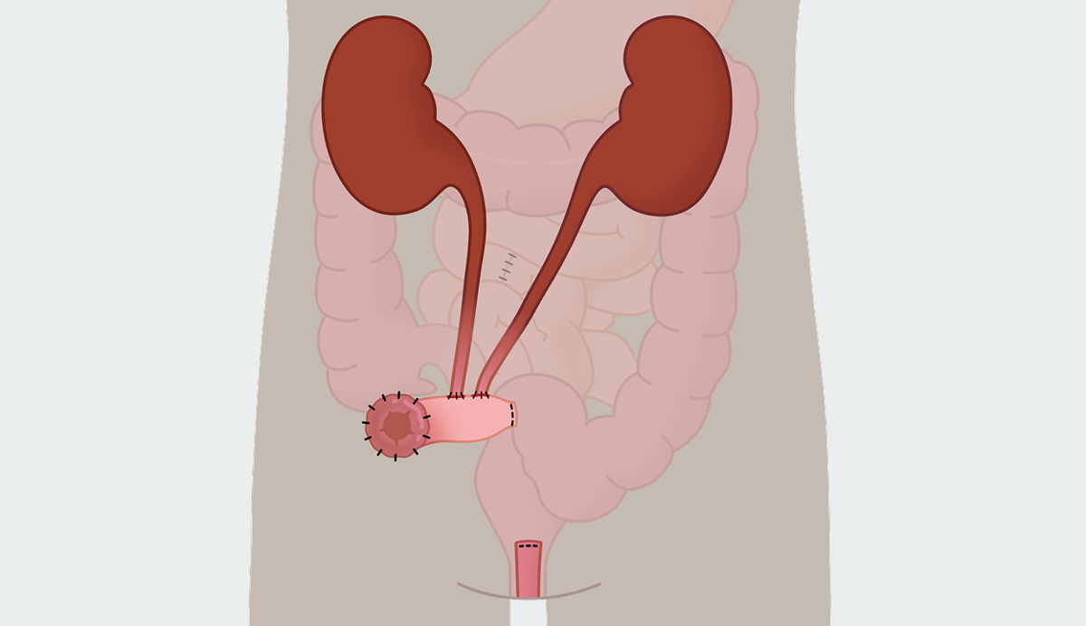 Illustration menschlicher Körper zeigt Anlage eines Urostomas