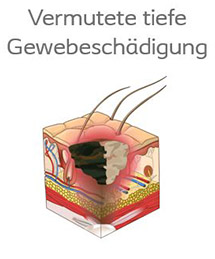 Dekubitus vermutete Gewebesch&auml;digung