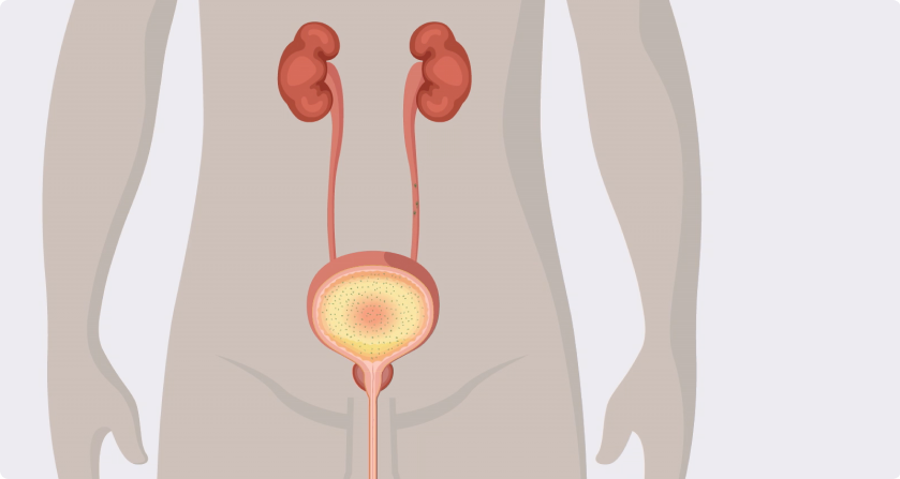 Comment la prolifération bactérienne augmente le risque d'infection urinaire
