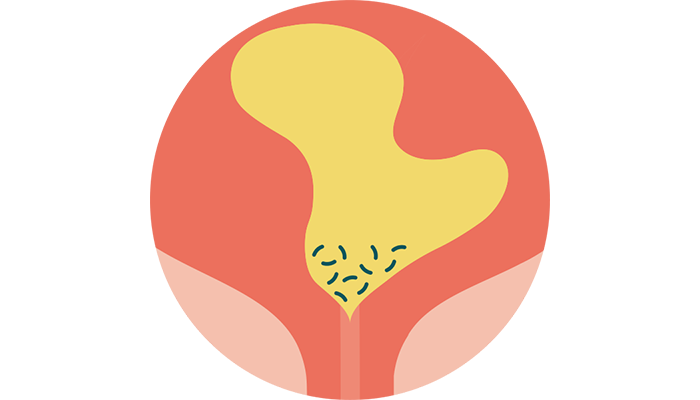 Quel est le lien entre l'urine résiduelle et les infections urinaires?