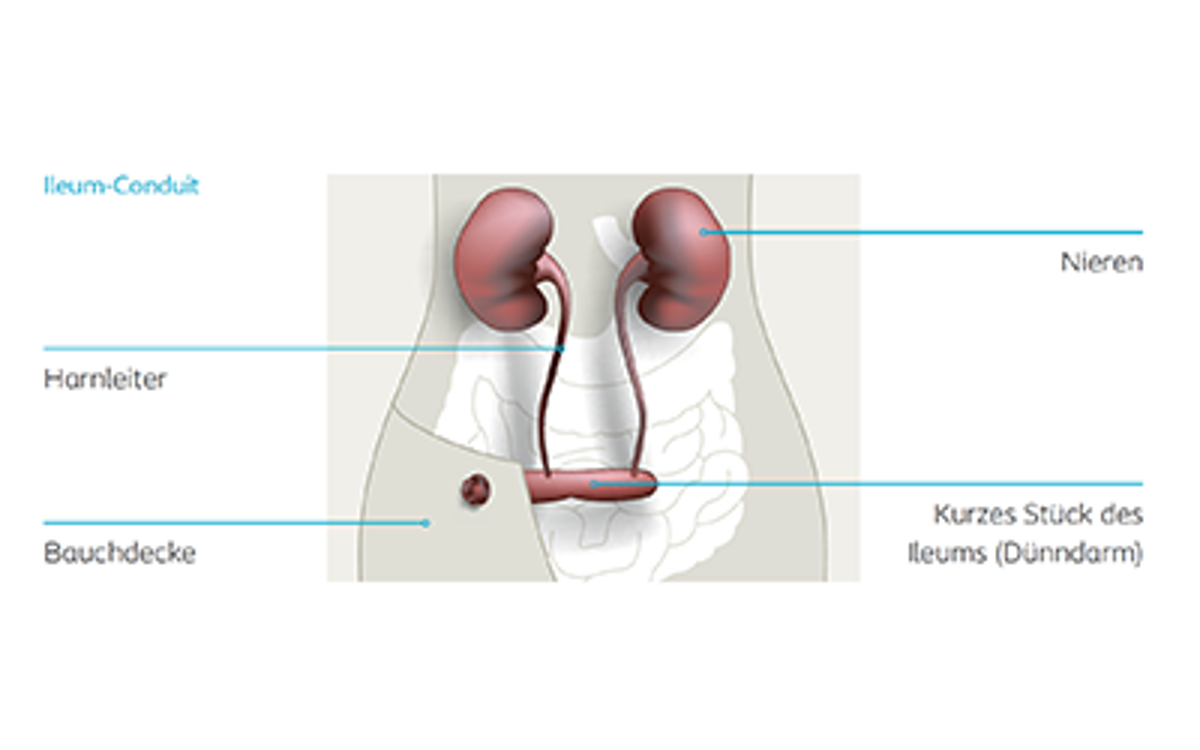 Illustration eines Ileum-Conduits mit Beschriftungen