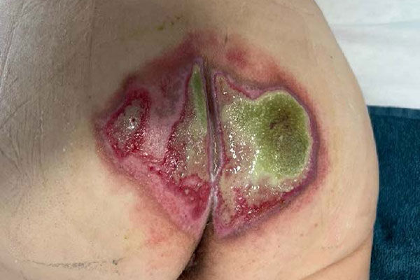 Fallverlauf Dekubitus nach Bypass-OP: Tag 0
