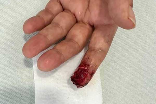 Schnittwunde am Finger Tag 0