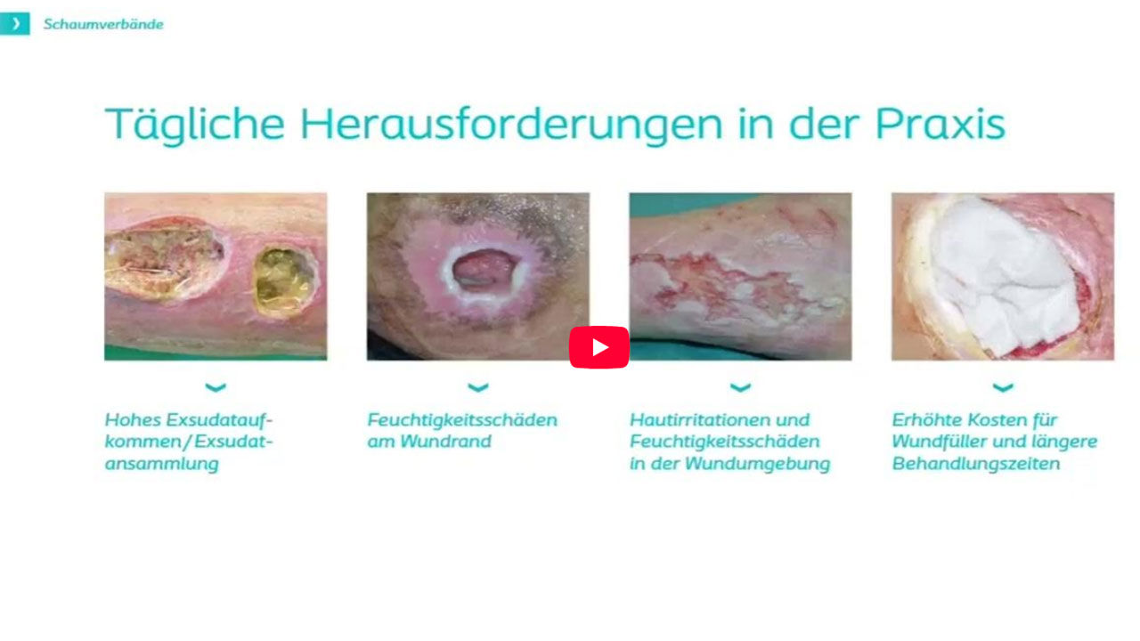Teaser: Exsudatansammlungen vermeiden – Die Wölbung bringt den Unterschied​